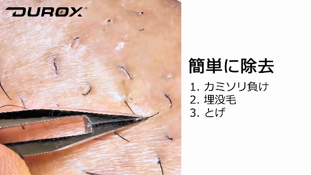 Amazon | DUROX 極細先細ピンセット（埋没毛）｜先細・ニードル